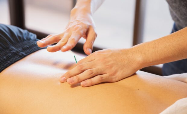 Dry needling